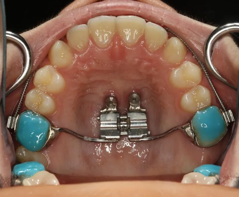 Czynniki wpływające na cenę leczenia ortodontycznego