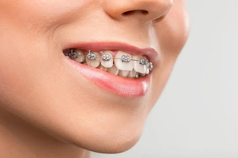 Koszt aparatu ortodontycznego 2026